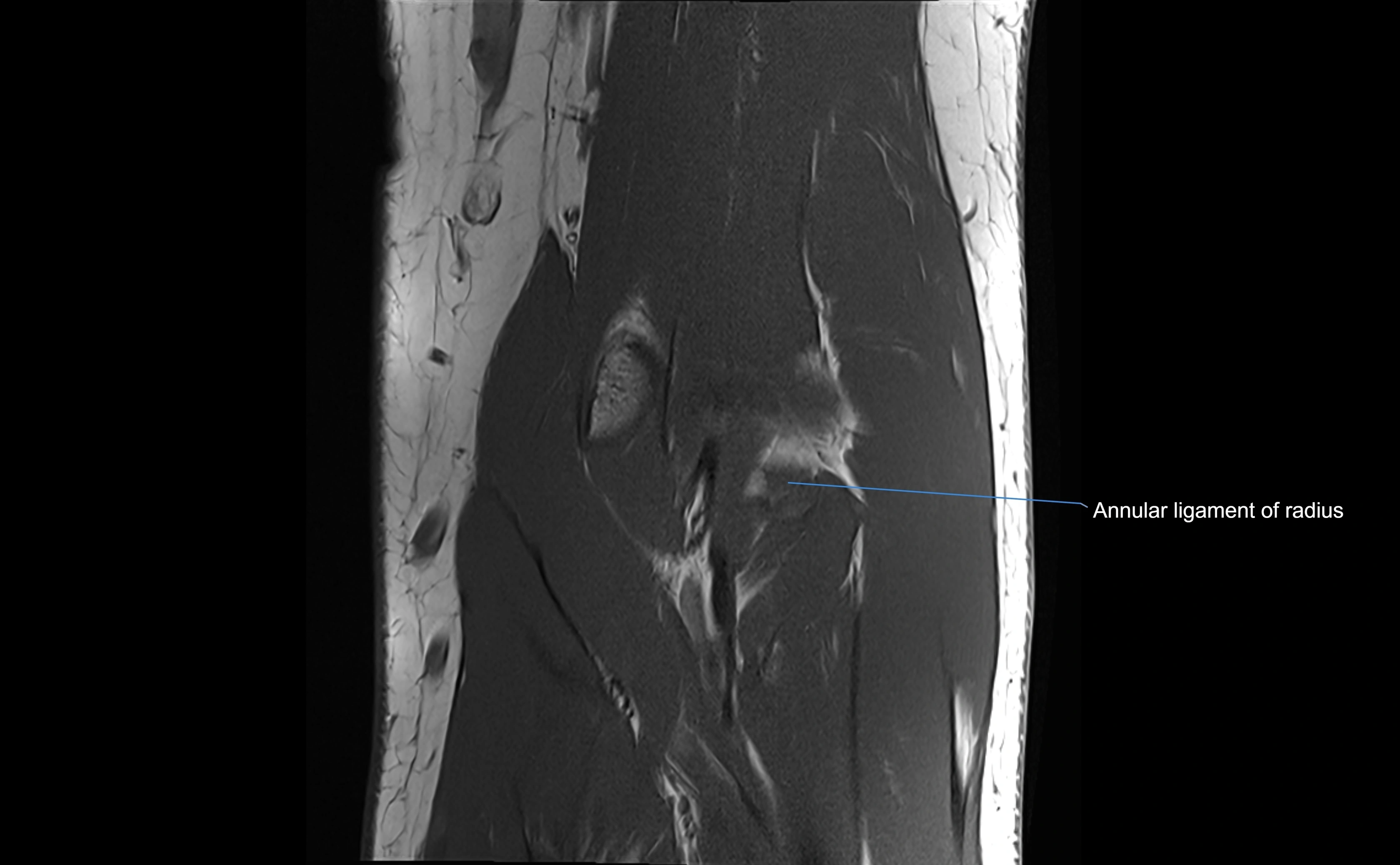 MRI elbow ligaments coronal cross sectional anatomy 3T  radiology  image-img-07001-00015.webp